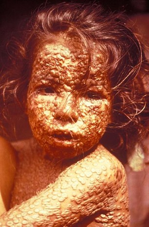 Small Pox